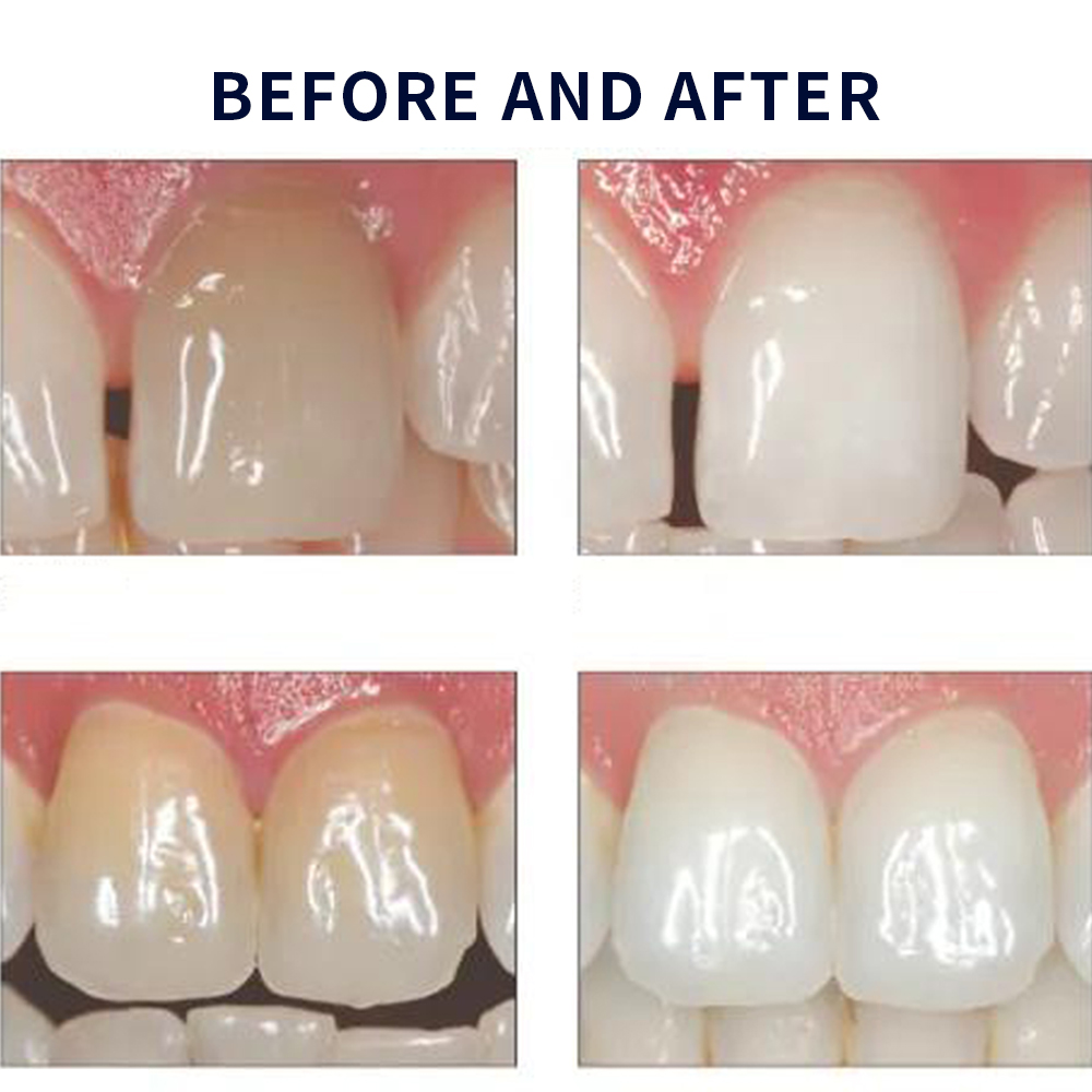 Opalescence Whitening 20% PF 2 - Teeth Whitening At Home ulasan dan harga