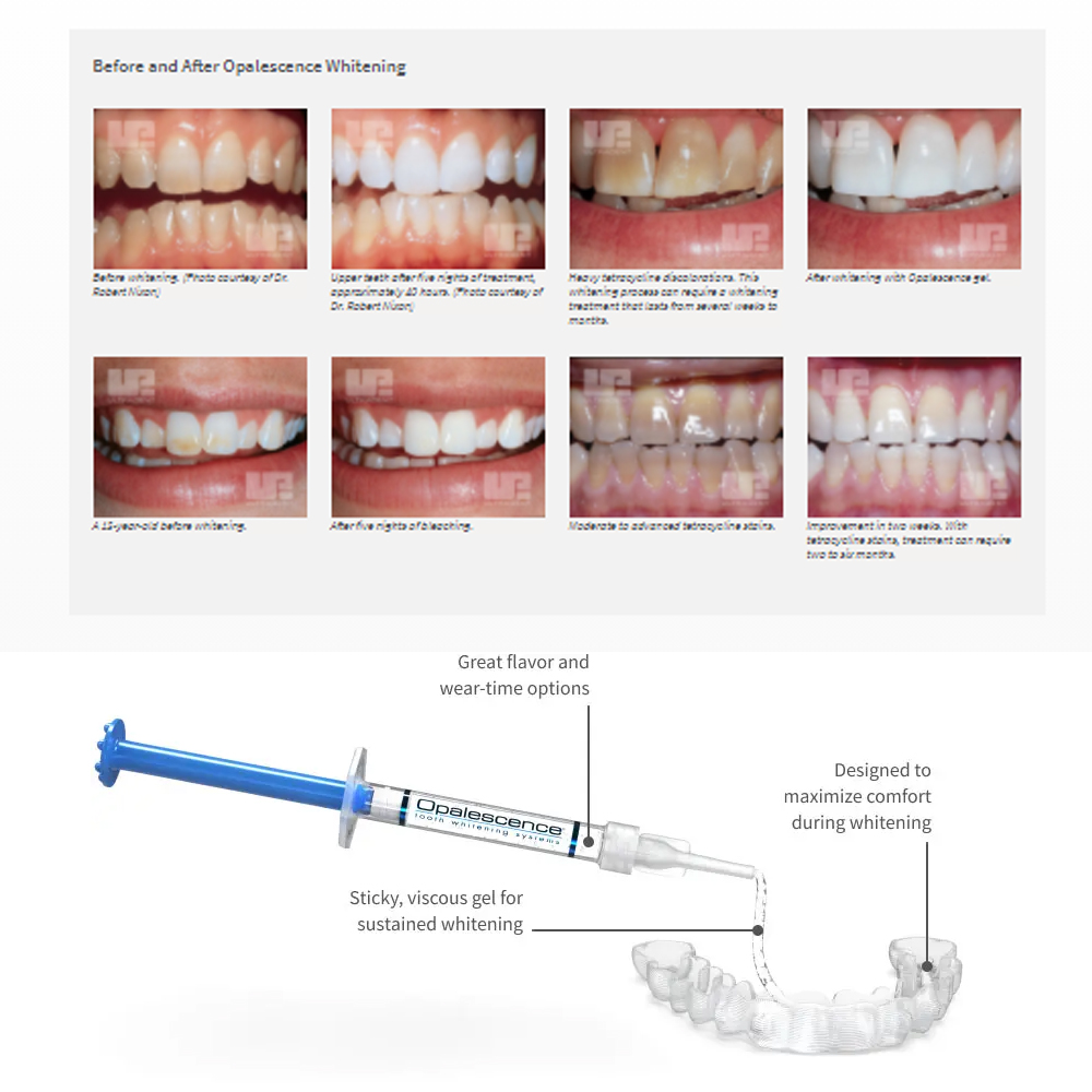 Opalescence Whitening 20% PF 2 - Teeth Whitening At Home ulasan dan harga