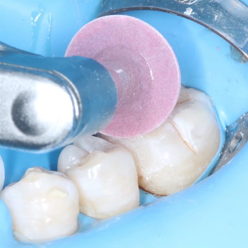 40Pcs Disc Poles Gigi Resin Ko - Teeth Whitening Home ulasan dan harga