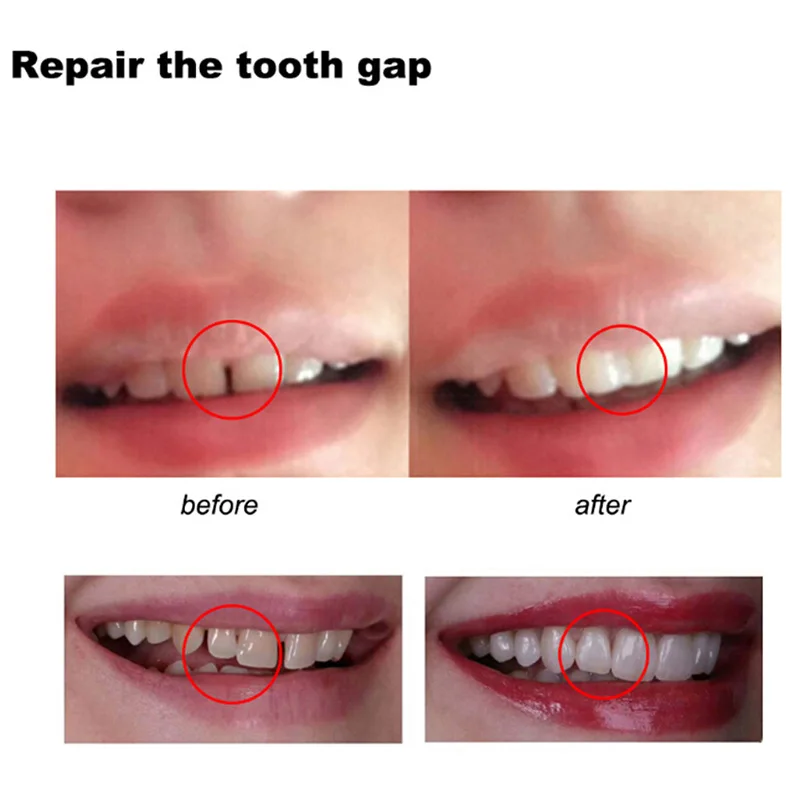 Lem perbaikan gigi dapat membe - Teeth Whitening At Home ulasan dan harga